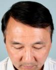 After Hair Transplant&nbsp;Front